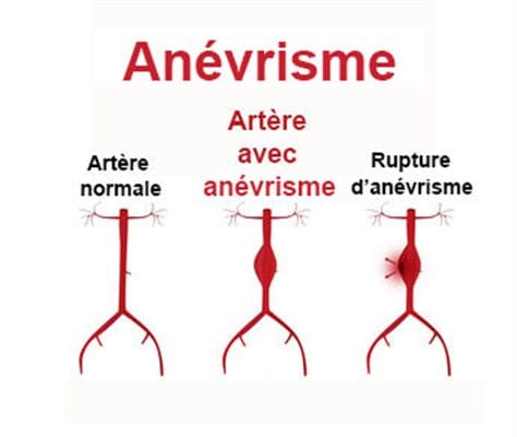 Conseils santé/Anévrisme: Astuces pour prévenir cette maladie et éviter un AVC hémorragique