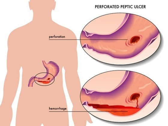 Conseils santé:/ Ulcère gastrique: Les causes et ce que vous devez ou évitez de faire