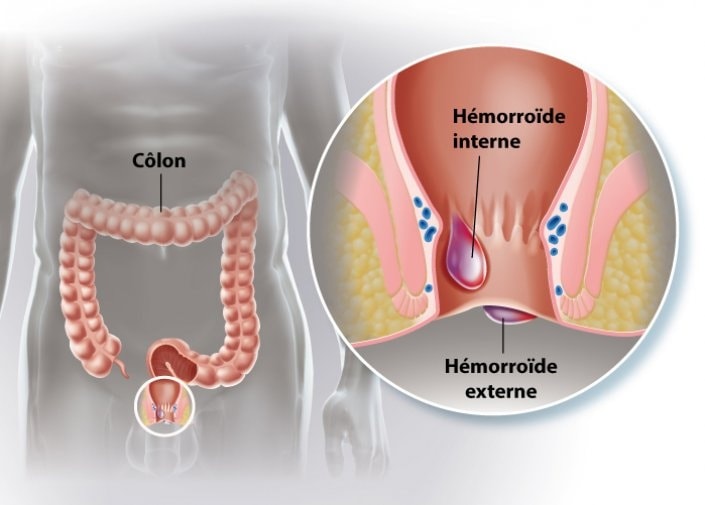 Maladie hémorroïdaire : Causes, traitements et ce qu’il faut éviter de faire
